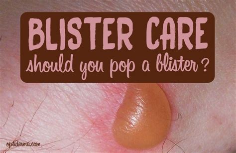 should you pop a blister can blisters heal without popping them