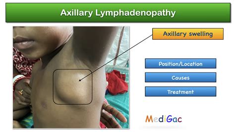 Axillary Lymphadenopathy Position Location Possible Causes