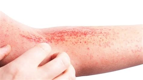 Tratamiento De La Dermatitis At Pica Un Gran Reto Para Los