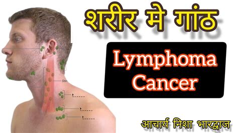 Lymphoma Signs And Symptoms Of Lymphoma Cancer The Main Cause Of