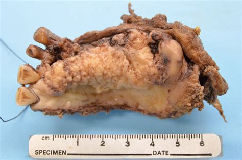 Head And Neck Squamous Cell Carcinoma Lmp18339 Lmp Digital