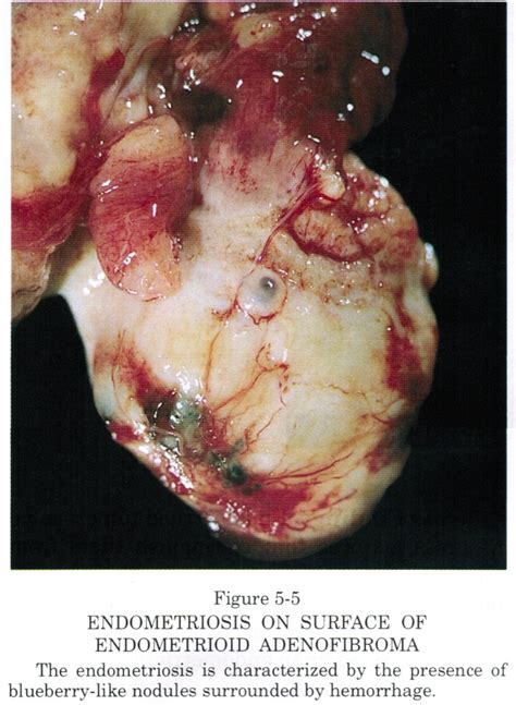 An der linden pj (1996). Pathology Outlines - Endometrioid adenofibroma