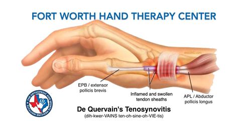 De Quervains Tenosynovitis Chronic Overuse And Strain On The Wrist