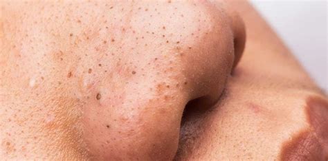 Acne Pop Up Comedones Zel Skin Laser Specialists