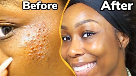 Diy How To Get Rid Of Acne Bumps And Textured Skin Fast In 4 Days