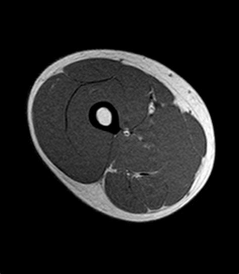 Broadly considered, human muscle—like the muscles of all vertebrates—is often divided into striated muscle. Normal MRI of the thigh | Image | Radiopaedia.org