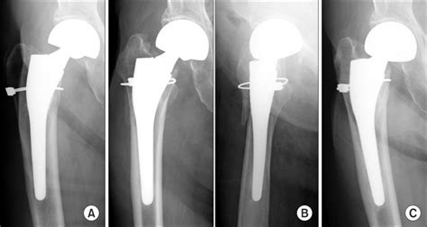 Case 17 A 91 Year Old Woman A Cementless Bipolar Hemiarthroplasty