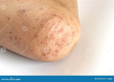 Eczema Stock Image Image Of Irritable Allergy Health 55747727