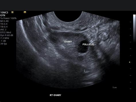Understanding Pelvic Ultrasound Reports Pelvic Ultrasound Results