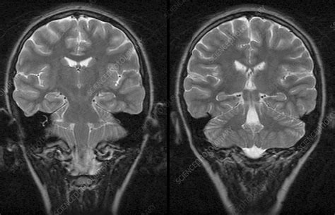 Normal Brain Mri Scan Stock Image C0030928 Science Photo Library