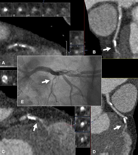 Ultra High Resolution Coronary Ct Angiography For Assessment Of