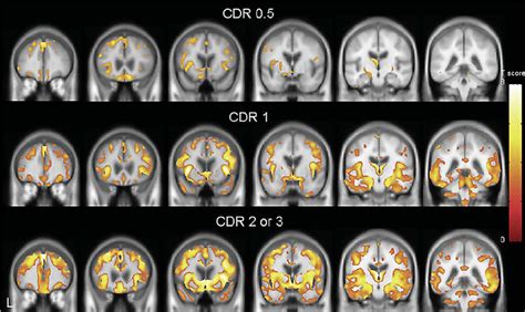 Patterns Of Gray Matter Loss In Subjects With Bvftd Grouped According