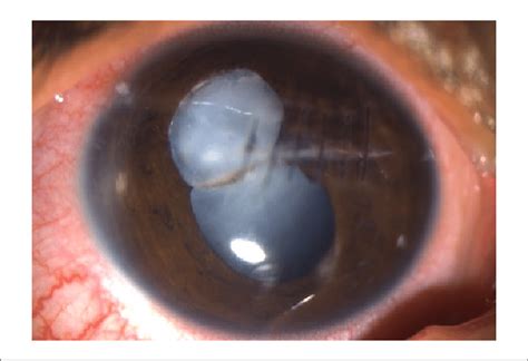 Slit Lamp Photograph Showing Ruptured Anterior Lens Capsule With