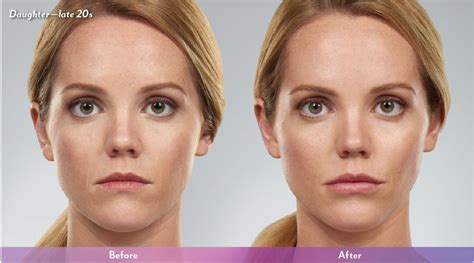 JuvÉderm Collection Of Fillers Sarah Sandell Md Facp And Susan Sleep Md