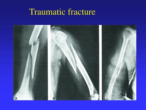 Ppt Trauma Fractures Dislocations Other Injuries Powerpoint The Best