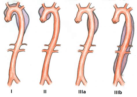 Thoracic Aortic Aneurysm Classification