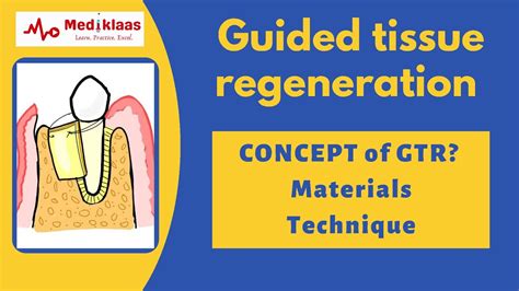 Guided Tissue Regeneration Concept Of Gtr I Periodontal Regeneration