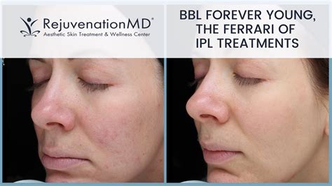Why Is Bbl Forever Young The Ferrari Of Ipl Treatments Youtube