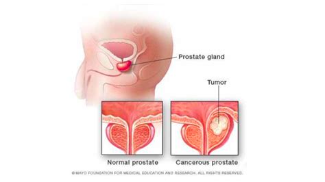 Mayo Clinic Minute What Black Men Need To Know About Prostate Cancer