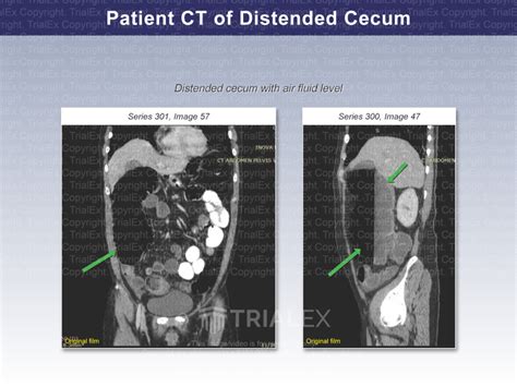 patient ct of distended cecum trial exhibits inc