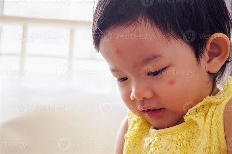 Cute Little Asian Girl With Allergy Red Spot Face Cause By Insect Bite