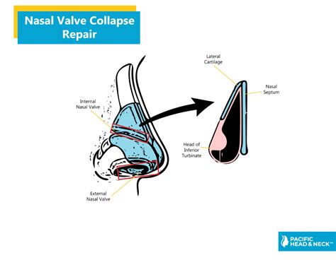 Nasal Valve Collapse Repair Pacific Eye And Ear Specialists