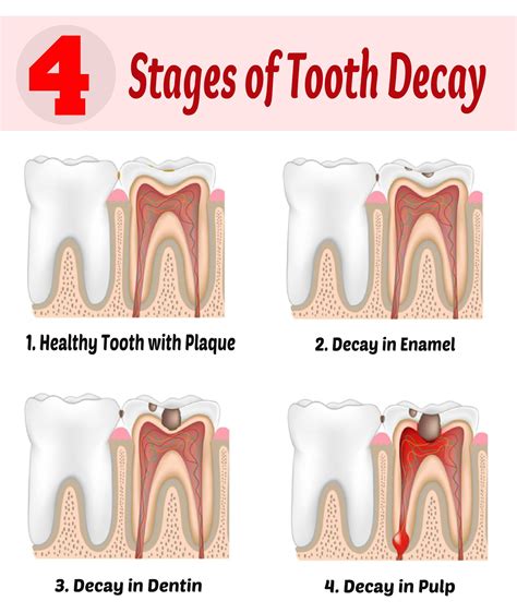 How To Stop Wisdom Tooth Pain Unugtp