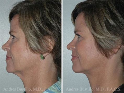 Minimal Incision Neck Lift Photos Miami Fl Patient 15769