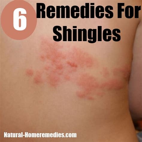 The answer might surprise you. Home Remedies For Shingles - Natural Treatments & Cure For ...
