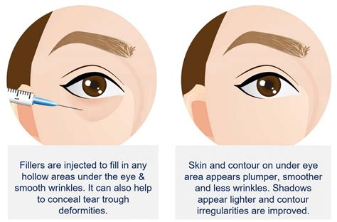 How To Erase Dark Circles Under The Eyes With Dermal Filler Injections