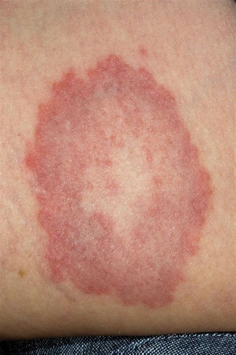 Granuloma Annulare On The Skin Photograph By Dr P Marazziscience