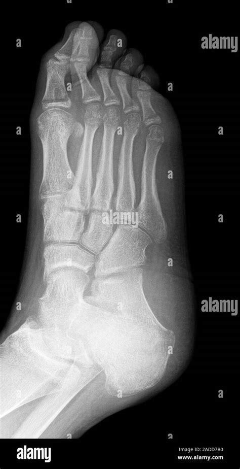 De Desmineralización De Los Huesos Del Pie X Ray Desmineralizar Es La