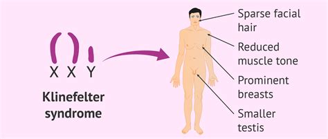 Klinefelter Syndrome All You Need To Know Sdlgbtn OFF