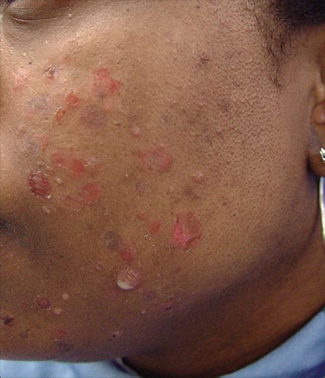 Bullous Impetigo Of The Face After Epilation By Threading Dermatology