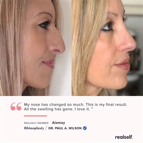 3 Women Open Up About Their Rhinoplasty Recovery Journeys