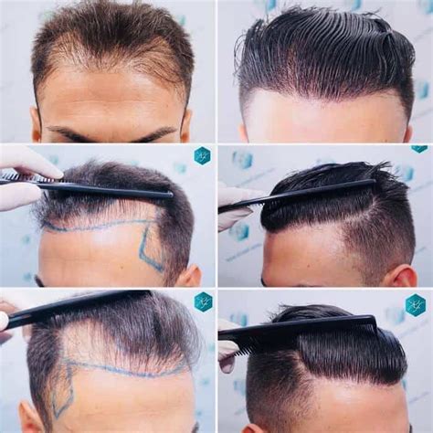 How To Fix Messed Up Hairline Things You Can Do