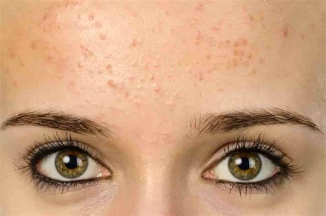 Why Does Forehead Acne Occur And How Does It Go Away