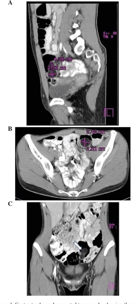 Figure 1 From Laparoscopic Resection Of A Sigmoid Colon Lipoma In A