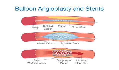 Coronary Angioplasty Stent Procedure Treatment By Dr Raghu Cardiologist