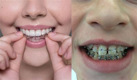 Invisalign Vs Braces Differences Treatment Time And Benefits