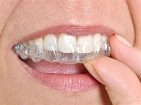 What Is The Difference Between Invisalign And Invisalign Lite