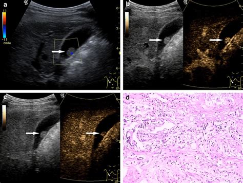 Gallbladder Adenoma A Ultrasonography Us Showed An Isoechoic Lesion