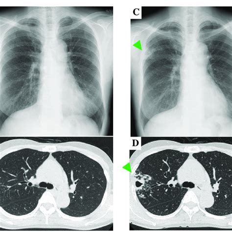 Serial Changes On Chest X Ray And Chest Computed Tomography Findings A