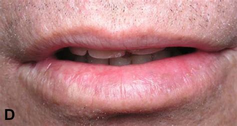 What Does Lip Cancer Look Like Pictures Cancerwalls