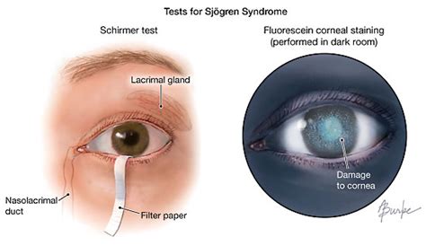 Reasonably Well Attention Men With Sjogrens Higher Incidence Of