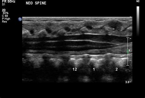 Neonatal Spine Normal Ultrasoundpaedia Neonatal