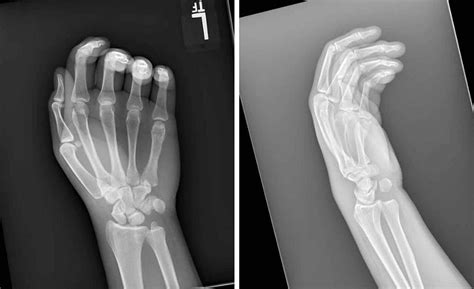 Dislocation Wrist Distal Radial Ulnar Joint Druj Hand Vrogue Co
