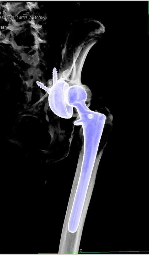 Failed Left Total Hip Replacement Musculoskeletal Case Studies