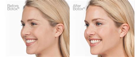 Best Botox Treatment And Botox Therapy In Coimbatore Botox Injection