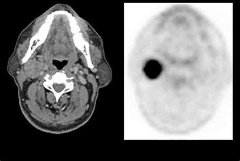 Ct And Pet Images Of An Axial View Of A Neck Showing Metabolically
